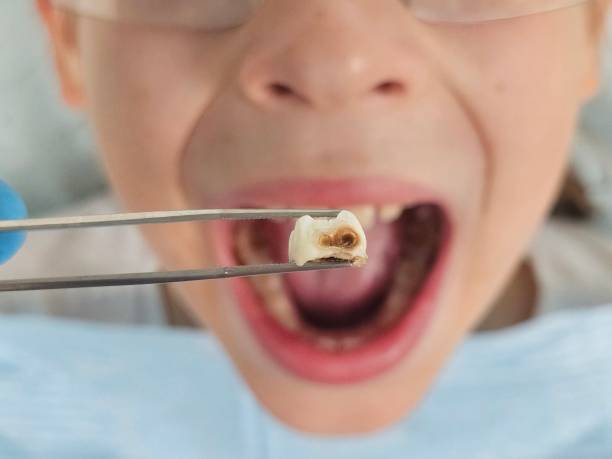 Best Emergency Dental Care for Broken or Chipped Teeth in Maple Lake, MN